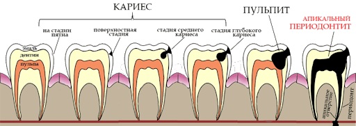 Стадии кариеса поэтапно